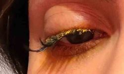 Güzellik salonunda gözüne yapıştırıcı kaçtı