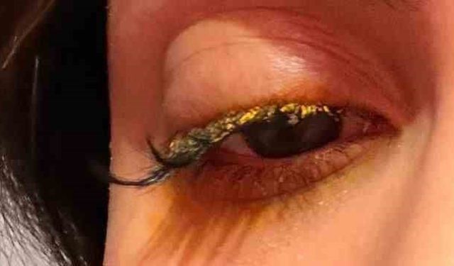 Güzellik salonunda gözüne yapıştırıcı kaçtı